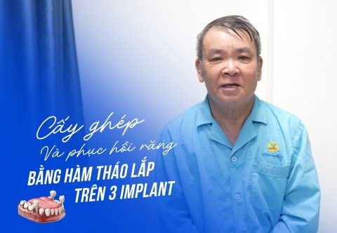 Thạc Sĩ Bác Sĩ Trần Phương Bình Cấy Ghép Implant Trên Xương Hàm Đã Ghép Vạt Xương Mác
